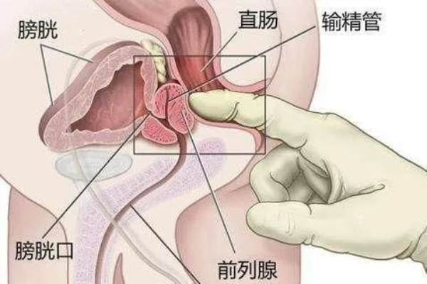 【学科建设】我市成功自主开展首例腹腔镜下前列腺癌根治术