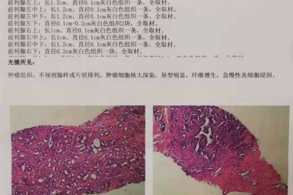 【学科建设】我市成功自主开展首例腹腔镜下前列腺癌根治术