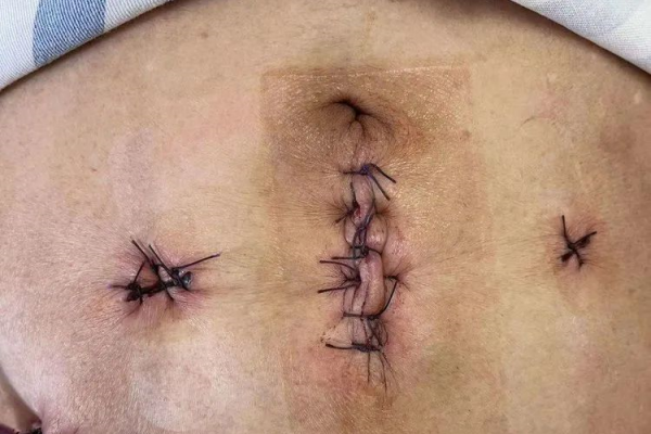 【学科建设】我市成功自主开展首例腹腔镜下前列腺癌根治术