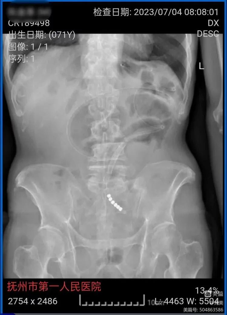 【学科建设●普外科】抚州市第一人民医院普外科开展DSA引导下肠梗阻导管置入术