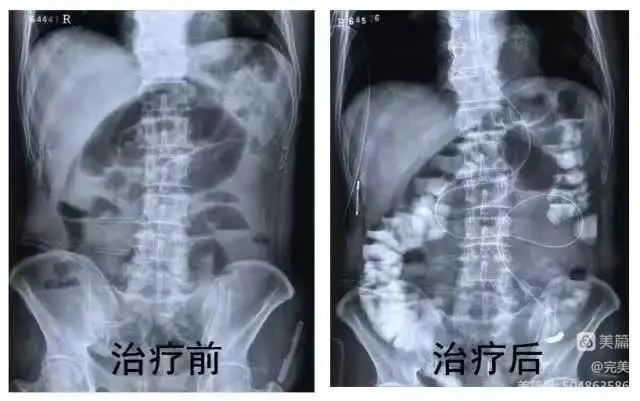 【学科建设●普外科】抚州市第一人民医院普外科开展DSA引导下肠梗阻导管置入术