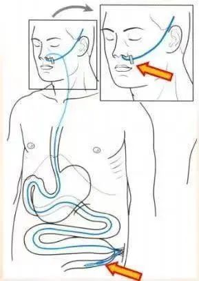 【学科建设●普外科】抚州市第一人民医院普外科开展DSA引导下肠梗阻导管置入术