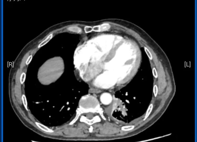 我院呼吸与危重症医学科开展超声支气管镜小探头引导下肺活检术（EBUS- TBLB）