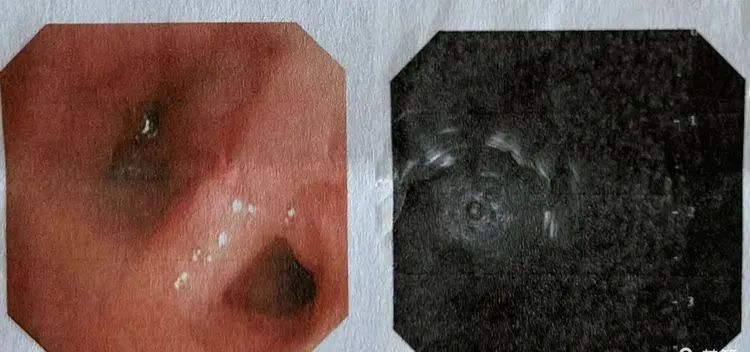 我院呼吸与危重症医学科开展超声支气管镜小探头引导下肺活检术（EBUS- TBLB）