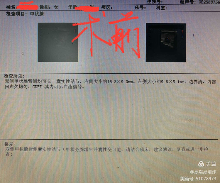 我院胸外科成功独立完成抚州首例双侧甲状旁腺全切除+自体甲状旁腺移植术