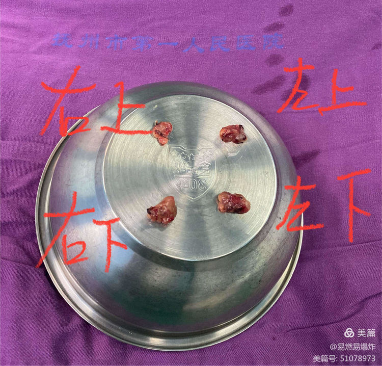 我院胸外科成功独立完成抚州首例双侧甲状旁腺全切除+自体甲状旁腺移植术