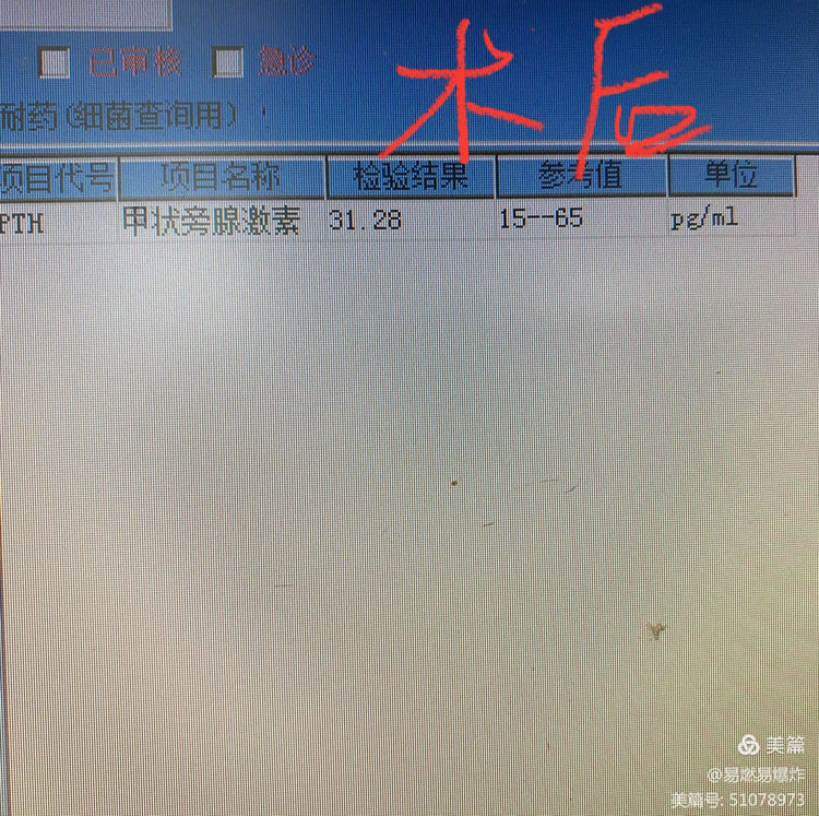 我院胸外科成功独立完成抚州首例双侧甲状旁腺全切除+自体甲状旁腺移植术